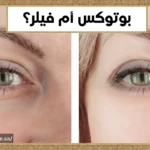 الفرق بين البوتكس والفيلر وأين يُفضّل إجراء الحقن بأمان؟